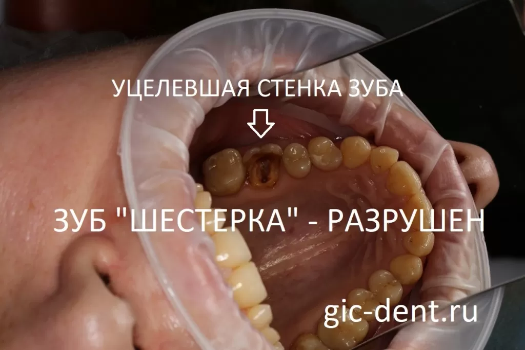 Уцелевшая стенка зуба - шестерки. Зуб восстановлению не подлежит в силу серьезных разрушений
